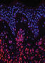 Melanoma-promoting gene discovered