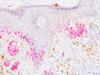 Immunity drives cancer into permanent growth arrest